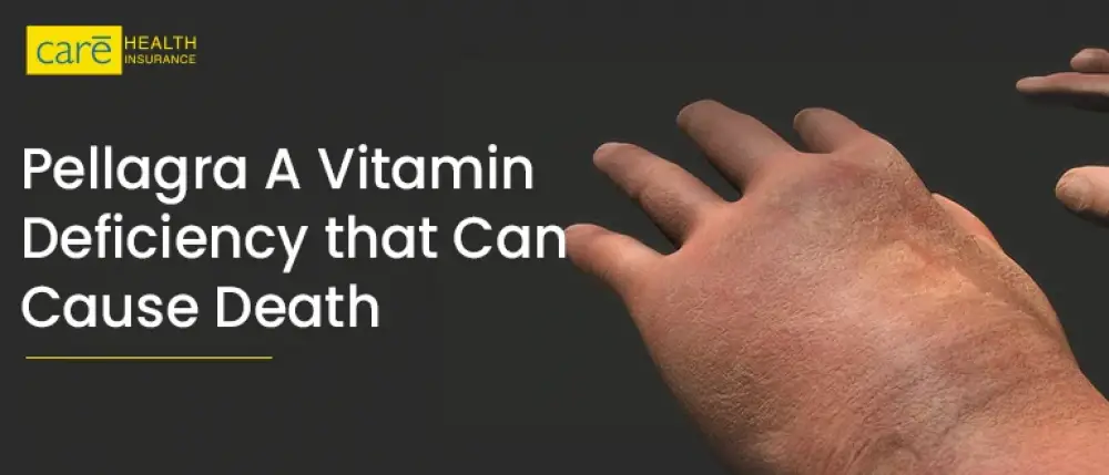 Pellagra: A Vitamin Deficiency that Can Cause Death